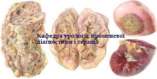 СРС та інтернів. ТУБЕРКУЛЬОЗ СЕЧОВИХ ШЛЯХІВ І ОРГАНІВ ЧОЛОВІЧОЇ СТАТЕВОЇ СИСТЕМИ. ZSMU_UR_M1_C05