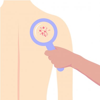 Dermatology, venereology. Homework DV_M6_C09