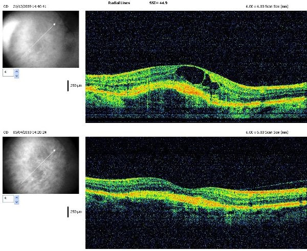 Вікова макулярна дегенерація Ophthal_PhD_C003
