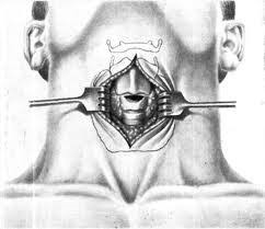 Obstruction of the upper respiratory tract 